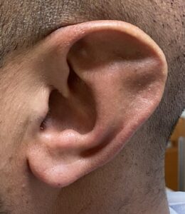 Stahl’s ear