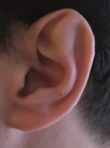 Stahl’s ear