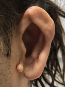 Constricted ear