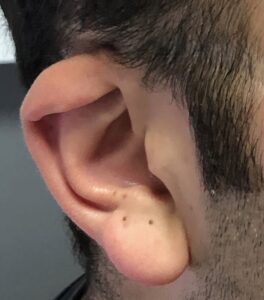 Cup ear