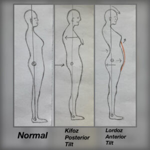 Omurgadaki duruş bozuklukları