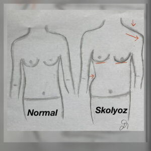 Skolyozisde meme anatomisine örnek