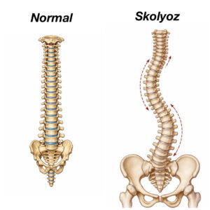 Skolyozis