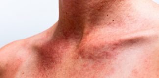 Deri Tümörleri deri kanseri