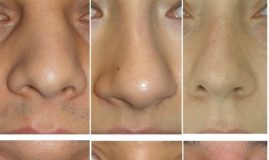 Eğri burun estetiği