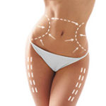 liposuction-hakkinda