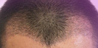 Saç Ekimi saç ekimi