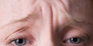 Kaş arası çizgiden nasıl kurtulursunuz?
