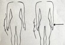 Hip dips nedir, nasıl tedavi edilir? kalça çukuru nedir