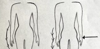 Hip dips nedir, nasıl tedavi edilir? kalça çukuru nedir