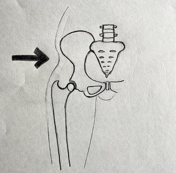 kalçada çukur deformitesi