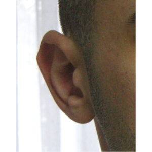 kulak kıkırdak anomalisi