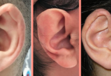 Kulakta heliks kıvrımı problemlerinin onarımı Kulakta kıkırdak problemleri