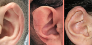 Kulakta heliks kıvrımı problemlerinin onarımı Kulakta kıkırdak problemleri