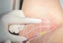 Aşırı terleme (primer hiperhidroz) Koltuk altında botoks ile aşırı terleme tedavisi uygulaması