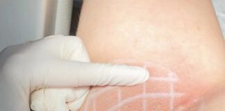 Aşırı terleme (primer hiperhidroz) Koltuk altında botoks ile aşırı terleme tedavisi uygulaması